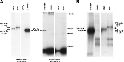 Fig. 1. Biochemical assays of proteins extracted from cytocentrifuge preparations and cryostat tissue sections. (A) Western blotting. Anti-ALK (ALKc) identifies the 80-kD NPM-ALK protein present in lysates of SU-DHL-1 cells. This protein is also detected by anti-NPM (NA24). In contrast, anti-ALK detects a protein of 85 kD in lysates from case #789 and a protein of 97 kD in lysates from case #862 but only wild-type 38-kD NPM are present in these cases. Normal tonsil contains no ALK protein and only wild-type NPM. (B) In vitro kinase assay. Kinase activity is present in the 80-kD NPM-ALK protein present in the SU-DHL-1 cell line, in an 85-kD ALK protein present in case #789, and in a 97-kD ALK protein present in case #862. No corresponding band is detected in the tonsil used as negative control.