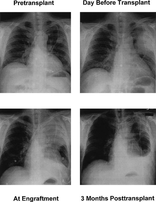 Fig. 2. Chest x-rays. (Top left) Seven days before HSCT. (Top right) One day before HSCT. (Bottom left) Day 10 after HSCT. (Bottom right) Three months after HSCT.