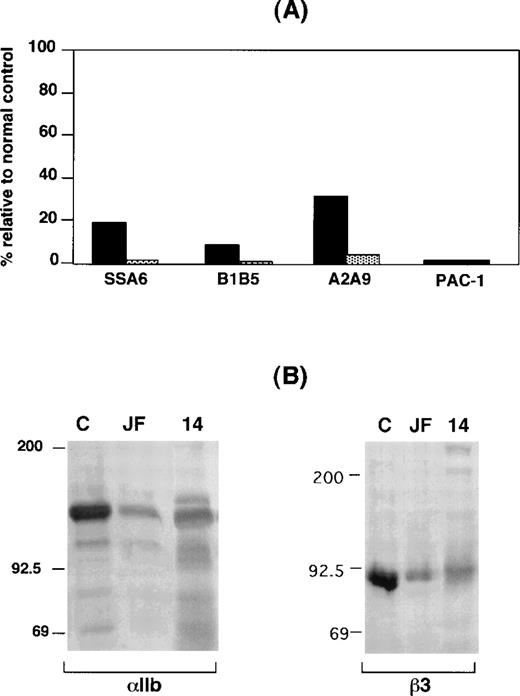Fig. 1. IIbβ3 expression in platelets from patients GW, JF, and Chinese-14. / (A) Flow cytometric analysis of platelets from patient GW (solid bars) and a patient with a known deficiency of surface αIIbβ3 receptors (FLD)14 (shaded bars). Data are expressed relative to a concurrently studied normal control (100%), whose platelets are known to express normal amounts of αIIbβ3.1426 Measurements of the binding of the β3-specific monoclonal antibody SSA6, the αIIb-specific monoclonal antibody B1B5, the αIIbβ3-specific monoclonal antibody A2A9, and the GPIb-specific monoclonal antibody AP1 were performed with the use of unstimulated platelets. PAC1 binding was measured after stimulating platelets with the phorbol myristate acetate. (B) Immunoblots of separated proteins from the platelets of patients JF and Chinese-14 and a normal control (labeled C) were performed with the use of the anti-αIIb heavy-chain–specific monoclonal antibody PMI-1 and the anti-β3–specific monoclonal antibody 7H2. Identical amounts of platelet protein from each subject were immunoblotted.