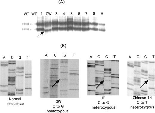 Fig. 2. Identification of mutations in IIb responsible for the thrombasthenia phenotype of patients GW, JF, and Chinese-14. / (A) Single-stranded conformation polymorphism analysis of αIIb exon 4 in 2 normal controls (WT), 8 unrelated thrombasthenic patients (lanes 1 and 3-9), and patient GW. An aberrantly migrating band in the sample from GW is indicated by the arrow. (B) Direct genomic sequence analysis of the region of interest of the αIIb gene from a normal individual, GW, JF, and Chinese-14. Differences from the normal sequence are indicated by the arrows. GW is homozygous for a mutation in the codon for P145, whereas both a normal and a mutant base are present in the JF and Chinese-14 sequences, indicating that they are heterozygous for this mutation.