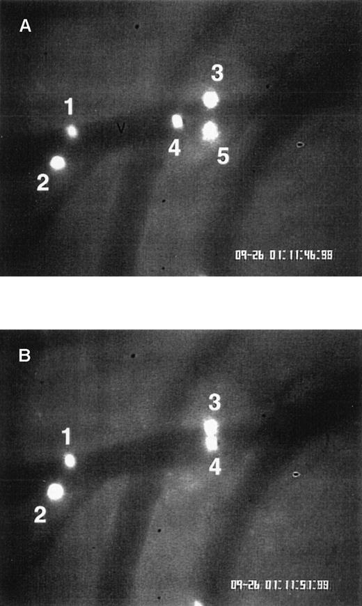 Fig. 4. Eosinophil rolling and firm adhesion visualized by intravital videomicroscopy. / Ragweed-sensitized wild-type mice were challenged with an intraperitoneal injection of ragweed. Twenty-four hours after intraperitoneal ragweed allergen challenge, fluorescence-labeled eosinophils were injected through the tail vein and visualized in vivo in the peritoneal microcirculation using intravital videomicroscopy. (A) A videotape image of eosinophils flowing through a postcapillary venule (V) is depicted. Blood flow in the venule is from left to right. (B) An image of the same venule is depicted, taken 5 seconds later than the image in panel A. Eosinophils 1, 2, and 3 remain stationary (same positions in panels A and B), representing eosinophils adherent to the venular endothelium. Eosinophil 4 transiently rolled on endothelium and is visible in panels A and B. Eosinophil 5 (panel A) became detached from the endothelium and is no longer visible in panel B.