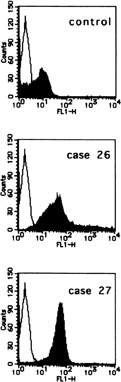Fig. 5. Flow cytometric analysis of the infiltrating adult T-cell leukemia (ATL) cells in lymph nodes. / CCR7/EBI1 expression levels of infiltrating ATL cells prepared from lymph nodes of 2 representative patients, patients 26 and 27, and control CD4+CD45RO+ T cells from reactive lymph nodes of HTLV-1-seronegative individuals were compared by flow cytometric analysis using an anti-CCR7 mAb, CCR7.6B3. The infiltrating ATL cells and control CD4+CD45RO+ T cells were purified by the negative immunoselection technique as described in Materials and Methods.