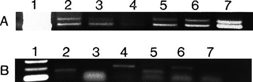 Fig. 5. Expression of VEGF (A) and bFGF (B) RNA in AML cells. / VEGF and bFGF expression was assayed by RT-PCR (see Methods) in AML cells freshly isolated from untreated patients and in HL-60 and U937 cells. Lane 1 = molecular weight (MW) marker; lanes 2 to 5 = AML patients; lane 6 = HL-60 cells; lane 7 = U937 cells. All samples expressed VEGF, whereas only 3 of 4 fresh samples and HL-60 cells expressed bFGF. Patient 4 had weaker VEGF expression than the others. Actin controls showed equal amounts of RNA (not shown). Negative controls without RNA and without reverse transcriptase were negative (not shown).