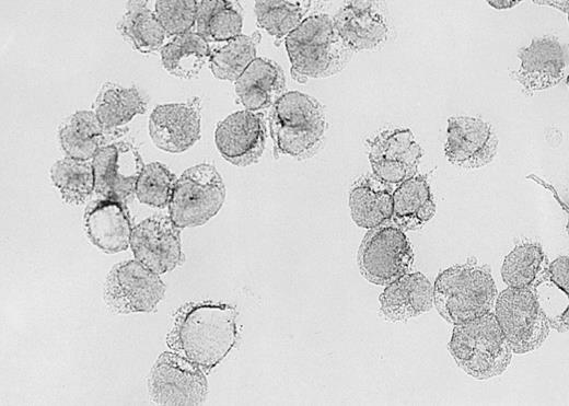 Fig. 6. Expression of VEGF protein in AML cells. / Cytospin of AML cells freshly isolated from an untreated patient was stained immunohistochemically for VEGF expression (see Methods). AML cells expressed VEGF protein in the cytoplasm, which is typical of this growth factor. Similar results were obtained with HL-60, U937, and 5 other fresh AML samples.