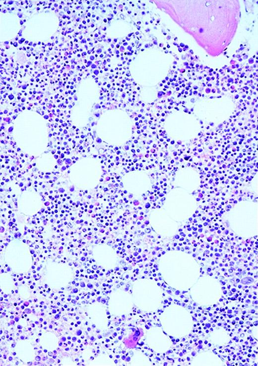 Fig. 1. Vascularity of normal and AML marrow specimens. / Normal or AML bone marrow samples were stained with H&E or for vWF expression (see Methods) for vessel scoring. Legends (all ×200): A = normal bone marrow with H&E stain; B = normal bone marrow with vWF stain; C = AML bone marrow with H&E stain; D = AML bone marrow with vWF stain. The normal bone marrow shows strong staining for vWF in megakaryocytes but no evidence of increased vessels. The AML marrow has significantly more vessels than the normal marrow. These sections are representative of the whole series.