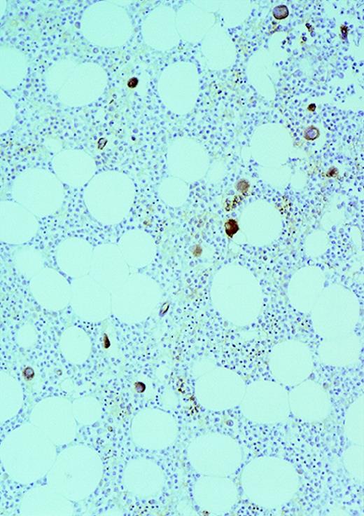 Fig. 1. Vascularity of normal and AML marrow specimens. / Normal or AML bone marrow samples were stained with H&E or for vWF expression (see Methods) for vessel scoring. Legends (all ×200): A = normal bone marrow with H&E stain; B = normal bone marrow with vWF stain; C = AML bone marrow with H&E stain; D = AML bone marrow with vWF stain. The normal bone marrow shows strong staining for vWF in megakaryocytes but no evidence of increased vessels. The AML marrow has significantly more vessels than the normal marrow. These sections are representative of the whole series.