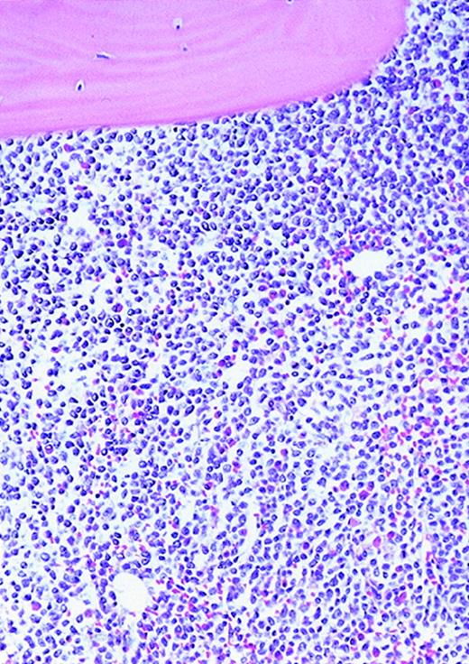 Fig. 1. Vascularity of normal and AML marrow specimens. / Normal or AML bone marrow samples were stained with H&E or for vWF expression (see Methods) for vessel scoring. Legends (all ×200): A = normal bone marrow with H&E stain; B = normal bone marrow with vWF stain; C = AML bone marrow with H&E stain; D = AML bone marrow with vWF stain. The normal bone marrow shows strong staining for vWF in megakaryocytes but no evidence of increased vessels. The AML marrow has significantly more vessels than the normal marrow. These sections are representative of the whole series.