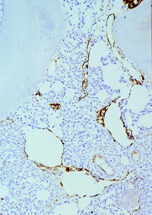 Fig. 1. Vascularity of normal and AML marrow specimens. / Normal or AML bone marrow samples were stained with H&E or for vWF expression (see Methods) for vessel scoring. Legends (all ×200): A = normal bone marrow with H&E stain; B = normal bone marrow with vWF stain; C = AML bone marrow with H&E stain; D = AML bone marrow with vWF stain. The normal bone marrow shows strong staining for vWF in megakaryocytes but no evidence of increased vessels. The AML marrow has significantly more vessels than the normal marrow. These sections are representative of the whole series.