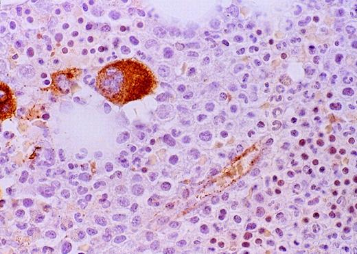 Fig. 2. High-power view of vascularity of normal and AML marrow specimens. / Normal or AML bone marrow samples were stained for vWF expression (see Methods). A = 600× view of normal bone marrow showing positive staining in a megakaryocyte as well as 1 vessel. B = 400× view of representative AML marrow showing numerous vessels. Note that some of the vessels are large with irregular and bizarre shapes. C = 600× view of representative AML marrow showing details of vascular endothelial cell staining.