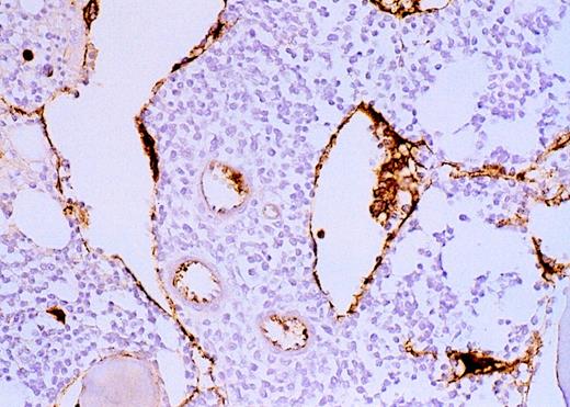Fig. 2. High-power view of vascularity of normal and AML marrow specimens. / Normal or AML bone marrow samples were stained for vWF expression (see Methods). A = 600× view of normal bone marrow showing positive staining in a megakaryocyte as well as 1 vessel. B = 400× view of representative AML marrow showing numerous vessels. Note that some of the vessels are large with irregular and bizarre shapes. C = 600× view of representative AML marrow showing details of vascular endothelial cell staining.