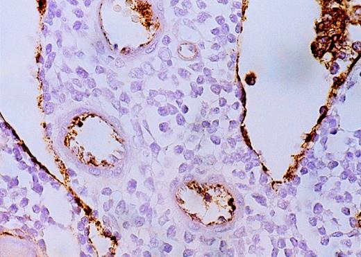 Fig. 2. High-power view of vascularity of normal and AML marrow specimens. / Normal or AML bone marrow samples were stained for vWF expression (see Methods). A = 600× view of normal bone marrow showing positive staining in a megakaryocyte as well as 1 vessel. B = 400× view of representative AML marrow showing numerous vessels. Note that some of the vessels are large with irregular and bizarre shapes. C = 600× view of representative AML marrow showing details of vascular endothelial cell staining.
