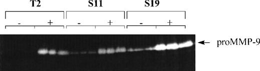 Fig. 1. Production and expression of MMP-9 by lymphoma cells in vitro. / Cells were cultured in triplicate in the absence (−) or presence (+) of 50 nM PMA for 12 hours. Supernatants were collected, lyophilized, and assayed for their gelatinase content by zymography. Results are representative of at least 3 independent experiments.