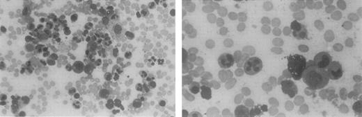 Fig. 1. Bone marrow aspirate from a patient with myelokathexis, revealing abundant cells of the neutrophil lineage. / Characteristic pyknotic nuclear lobes connected by fine chromatin filaments are present in the mature neutrophils.