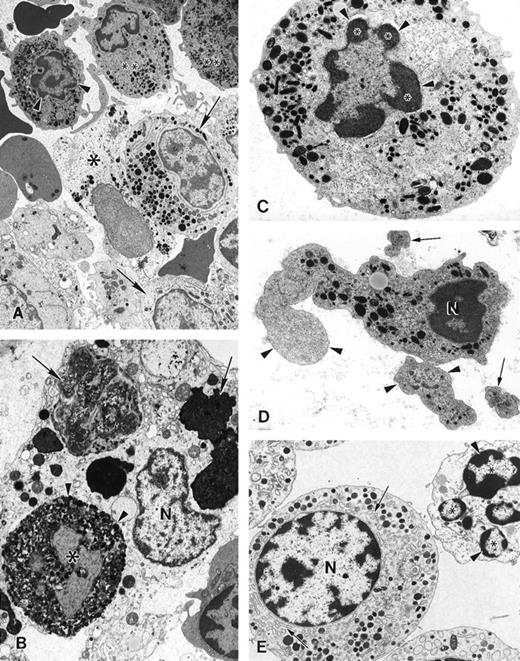 Fig. 4. Electron micrographs of bone marrow from patient 2 before granulocyte colony-stimulating factor treatment. / (A) Low magnification of the bone marrow shows degenerating cells (*), few mature neutrophils (**), and promyelocytes (arrows). Neutrophils with convoluted nuclei (arrowheads), a sign of early apoptosis, are observed. Magnification ×4000. (B) Macrophage in the bone marrow contains several phagosomes (arrows) with cellular debris of neutrophils. Neutrophil (arrowheads) with a distinguishable nucleus (*) and granules is discernible in 1 of the phagosomes. N, macrophage nucleus. Magnification ×6500. (C) Neutrophil in an early stage of apoptosis. The nucleus is convoluted (arrowheads), and the chromatin is condensed and distinctly circumscribed, forming dense granular masses (*) along the inner surface of the nuclear envelope. Magnification ×7500. (D) Neutrophil in a later stage of apoptosis. The cell shows cytoplasmic blebbing (arrowheads) and cellular fragmentation (arrow). N, nucleus. Magnification ×13,000. (E) Promyelocytes observed in the bone marrow. The cell at the bottom left appears normal and has a large, round nucleus (N), numerous granules, and a well-developed rough endoplasmic reticulum (arrows). The cell at the top right is apoptotic, as indicated by the fragmented nucleus (*), and has distinct areas of condensed chromatin (arrowheads). Magnification ×5500.