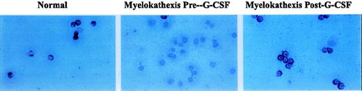 Fig. 6. Immunocytochemical detection of bcl-x expression in bone marrow-derived neutrophil precursor CD15+/CD34−/CD33− cells of a normal volunteer and patient 2 before and during treatment with G-CSF.