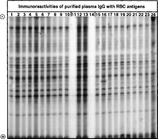 Fig. 1. Western blotting of IgG with extracts of normal human RBCs. / IgG purified from plasma of patients with WAIHA and healthy blood donors was immunoblotted at 200 μg/mL with a soluble extract of pooled RBCs of healthy donors, as described in Materials and Methods. Lanes 1 to 10: IgG of patients with WAIHA; lanes 15 to 24: IgG of healthy blood donors; lanes 12 and 13: normal reference IgG (IVIg); lanes 11 and 14: secondary anti-Fcγ antibody alone.