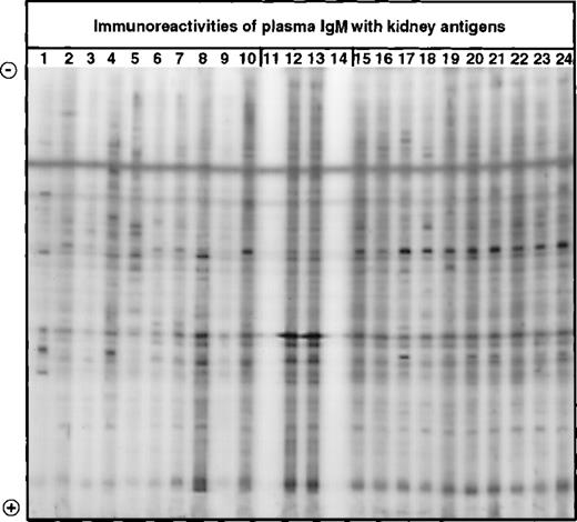 Fig. 4. Western blotting of IgM with extracts of normal human kidney. / IgM in the plasma of patients with WAIHA and healthy blood donors was interacted at 20 μg/mL with a soluble extract of kidney antigens, as described in Materials and Methods. Lanes 1 to 10: IgM of patients; lanes 15 to 24: IgM of healthy blood donors; lanes 12 and 13: normal reference IgM (IVIgM); lanes 11 and 14: secondary anti-Fcμ antibody alone.