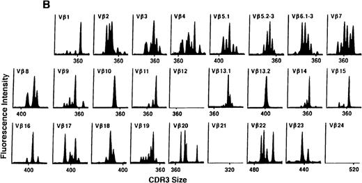 Fig. 1. The pretransplant TCR Vβ repertoire of 1 donor (A) and recipient (B) pair.