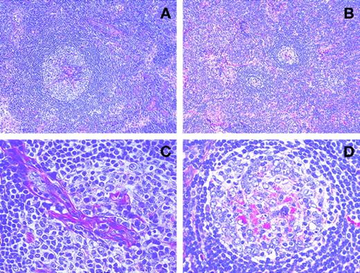 Fig. 3. Serial histopathologic changes with rhPM-1 therapy. / Hyperplastic lymph follicle with hyalinous capillary vessels penetrates into the germinal center before rhPM-1 treatment (A and C). Note reduction in both the size of lymph follicles and in the vascularity of germinal centers with residual eosinophilic deposits after rhPM-1 therapy (B and D). (Hematoxylin-eosin, A and B, original magnification ×100; C and D, original magnification ×400).