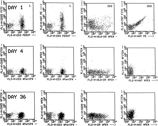 Fig. 2. Flow cytometric analysis of peripheral blood lymphocytes of a patient treated with daclizumab. / The dot plots in the first two columns are gated on lymphocytes, and those in the third and fourth columns are gated on CD3+cells. Following treatment, p55 is not detected by anti-CD25 nor by anti-humanized Tac (daclizumab) on CD3+ cells (first and second columns), but the CD3+ cells remain positive for HLA-DR (third column) and faintly positive for p55 using 7G7 (fourth column).