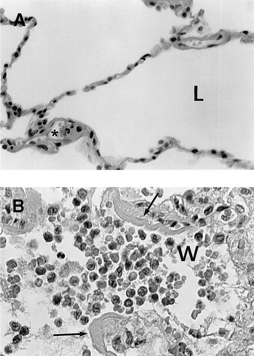 Fig. 2. Histologic findings in cases with fatal retinoic acid syndrome. / (A) Histologic appearance of normal lung tissue. L shows lung alveolae in normal lung; * indicates normal neutrophil in microvasculature. (B) Lung tissue showing infiltration of alveolae with leukocytes from a patient who succumbed to the retinoic acid syndrome. W shows myeloid cells in the airspace (most leukocytes to left of “w”); the lobated nuclei of myeloid cells is prominently seen. Arrows indicate fibrinous exudate due to vascular leak of serum fibrin.