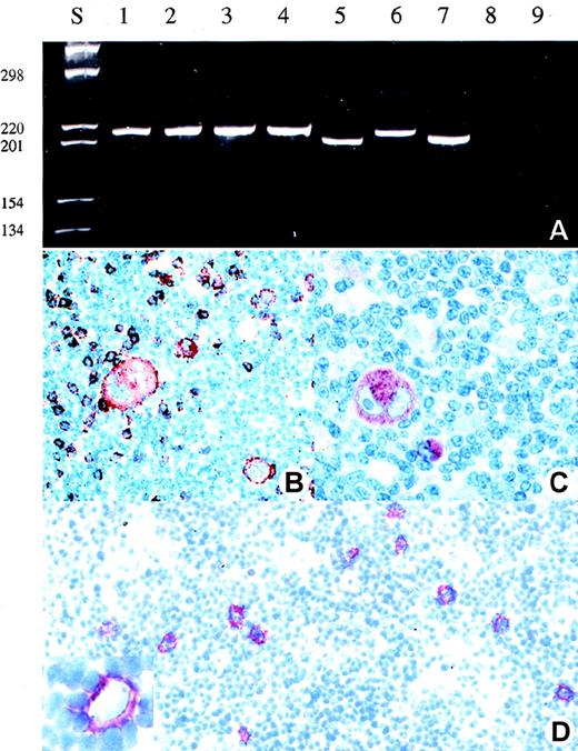 Fig. 1. Detection of clonal TCR-γ rearrangement and expression of T-cell marker in the HRS cells of patient 1. / (A) Analysis of the amplificates obtained after single copy TCR-γ PCR in single HRS cells (lane 1-4), reactive T-cells (lane 5-7), buffer control (lane 8), and negative control (lane 9) (B-cell line Raji) (polyacrylamide gel stained with ethidium bromide). (B) and (C) Immunohistologic staining for perforin (B) and CD8 (C) (APAAP staining). (D) CD30 staining of a frozen section from which the single HRS cells or their nuclei were isolated. In the insert, a Hodgkin cell is shown following isolation of its nucleus by micromanipulation.