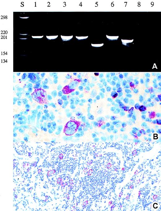 Fig. 2. Detection of clonal TCR-γ rearrangement and expression of perforin in the Hodgkin and Reed-Sternberg cells of patient 2. / (A) Analysis of the amplificates obtained after single copy TCR-γ PCR in single HRS cells (lane 1-4), reactive T-cells (lane 5-7), buffer control (lane 8), and negative control (lane 9) (B-cell line Raji) (polyacrylamide gel stained with ethidium bromide). (B) and (C) Immunohistologic staining for perforin (B) and CD30 (C) (APAAP staining). Note the perifollicular and noncohesive growth pattern of the CD30+ tumor cells.