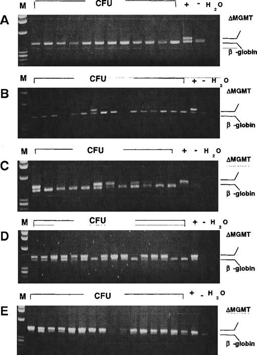 Fig. 2. In vivo selection for ▵MGMT-transduced CFU. / Representative PCR on genomic DNA obtained from individual bone marrow-derived CFU from mice in the 25 × 104 cohort given (a) 0 cycles (b) 1 cycle, (c) 2 cycles, or (d) 3 cycles of BG and BCNU; (e) mouse from 100 × 104 cohort given 3 cycles of BG and BCNU. +, positive control; −, negative control; H20, water control (no genomic DNA).
