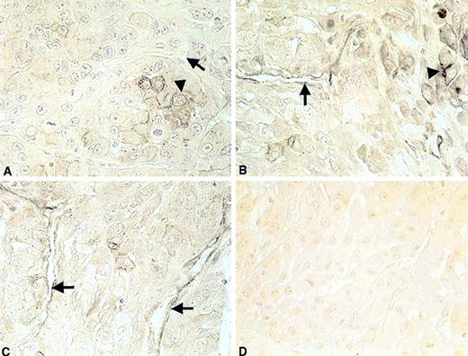 Fig. 8. Histochemical staining of tumor grown in mice with severe combined immunodeficiency with the human-specific anti-CEACAM1 monoclonal antibody 4D1/C2. / Panel (A) shows negative staining with 4D1/C2 in tumors grown after subcutaneous injection of A549 lung cancer cells. Panels (B) and (C) show positive staining of endothelial cells lining blood vessels in tumors initiated with A549 lung cancer cells plus AC133-derived putative endothelial cells. (D) Negative control (tumor tissue of mice injected subcutaneously with A549 lung cancer cells and AC133-derived putative endothelial cells). Tumor cells are indicated by arrowheads. Endothelial cells are indicated by arrows. Original magnification ×100.