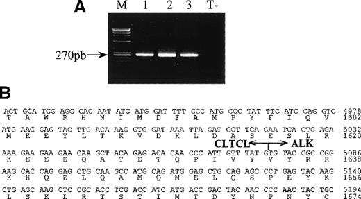Fig. 2. RT-PCR analysis of CLTCL-ALK and the sequence of the cloned CLTCL-ALK cDNA fusion junction. / (A) All samples show the expected 270 bp CLTCL-ALK RT-PCR product (M, size markers).Total RNA prepared from the 3 biopsy specimens (lane 1 and 2: axillary lymph nodes; lane 3: skin tumor) of case 1. RNA obtained from the NPM-ALK-positive SU-DHL-1 cell line was used as negative control (T−). RT-PCR was performed using 2 rounds of PCR. (B) Nucleotide and deduced amino acid sequences ofCLTCL-ALK cDNA. The arrow shows the translocation breakpoint. Nucleotides are numbered from the first nucleotide of the CLTCL transcript.