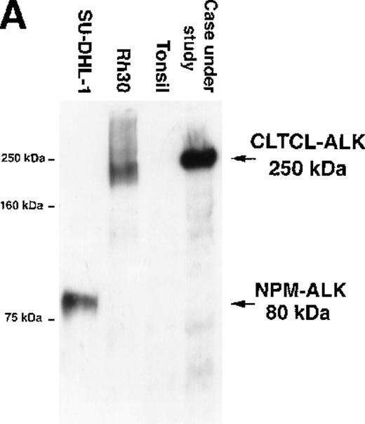 Fig. 3. Biochemical assays of proteins extracted from cryostat tissue sections. / (A) Western blotting using a 5.5% acrylamide gel. Anti-ALK (ALKc) detects a 250 kd band in lysates from the ALCL case expressing the CLCTL-ALK transcripts. This ALK protein is of a higher molecular weight than the normal 200 kd ALK protein present in the Rh30 cell line and the oncogenic 80 kd NPM-ALK expressed by the SU-DHL-1 cells. No ALK proteins were detected in tonsil lysates used as negative controls. (B) In vitro kinase assay using a 7.5% acrylamide gel. A phosphorylated 250 kd protein is present in the CLTCL-ALK-positive ALCL case. The 80 kd NPM-ALK protein expressed by SU-DHL-1 cells is used as a positive control. No corresponding bands were present in tonsil lysates.