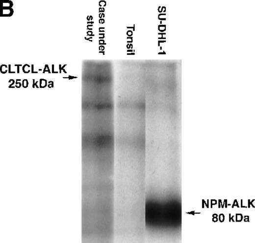 Fig. 3. Biochemical assays of proteins extracted from cryostat tissue sections. / (A) Western blotting using a 5.5% acrylamide gel. Anti-ALK (ALKc) detects a 250 kd band in lysates from the ALCL case expressing the CLCTL-ALK transcripts. This ALK protein is of a higher molecular weight than the normal 200 kd ALK protein present in the Rh30 cell line and the oncogenic 80 kd NPM-ALK expressed by the SU-DHL-1 cells. No ALK proteins were detected in tonsil lysates used as negative controls. (B) In vitro kinase assay using a 7.5% acrylamide gel. A phosphorylated 250 kd protein is present in the CLTCL-ALK-positive ALCL case. The 80 kd NPM-ALK protein expressed by SU-DHL-1 cells is used as a positive control. No corresponding bands were present in tonsil lysates.