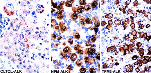 Fig. 1. ALK-staining patterns in anaplastic large cell lymphoma. / The cellular localization of the fusion protein is influenced by the ALK partner. The majority of anaplastic large cell lymphomas (70%-80%) are associated with the (2;5)(p23;q35) translocation and express NPM-ALK fusion protein. In such cases ALK staining is cytoplasmic, nuclear, and nucleolar associated. Approximately 10% to 20% (unpublished data) of cases carry the (1;2)(q25;p23) translocation and express the TPM3-ALK fusion protein, which is restricted to the cytoplasm (diffuse staining). In clear contrast, the 2 cases in the present study show intracytoplasmic finely granular clusters of staining, a pattern that differs clearly from those previously described (the 2 insets show single cells positive for CLTCL-ALK, at high power).