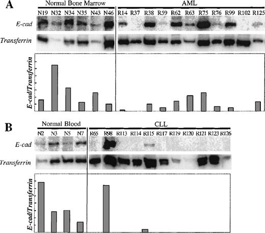 Fig. 1. Expression analysis of the E-cad gene. / (A) E-cadherin and transferrin receptor RT-PCR products were amplified from bone marrow samples from normal donors and patients with AML. (B) E-cadherin and transferrin receptor RT-PCR products were amplified from blood samples from normal donors and patients with CLL. E-cadherin PCR product is 310bp, and the transferrin receptor PCR product is 323 bp. The sample numbers are labeled above each lane (R, leukemic patient; N, normal sample). The relative amount of E-cadherin expression versus transferrin receptor expression (E-cad/transferrin) is expressed in the graph.
