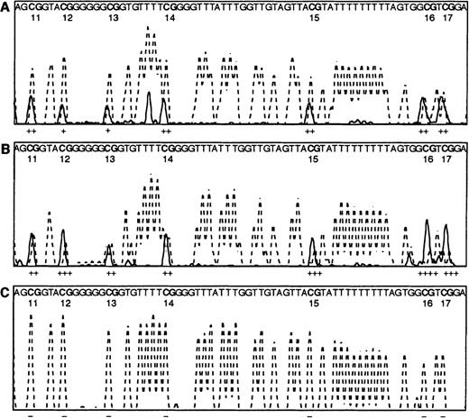 Fig. 4. Direct PCR bisulphite sequencing profiles. / Electrophoretograms of the CpG region of the E-cad gene from CpG dinucleotides 11-17 show the T peaks (dotted line) and C peaks (solid line) only. Note the sequence given within each panel is that of the bisulphite-converted DNA, except for the CpG dinucleotides that are shown as CG. The estimated amounts of methylcytosine, calculated by measuring the peak height of the cytosine over the peak heights of the cytosine plus thymine, are shown under each dinucleotide, where − indicates 0% methylation, + 1% to 25% methylation, ++ 26% to 50% methylation, +++ 51% to 75% methylation, and ++++ 76% to 100% methylation. (A) 50% methylated control PCR reaction, as described in Warnecke et al.23 (B) AML patient R99, with methylation throughout the region. (C) Normal bone marrow control N43, with no methylation evident throughout the region.