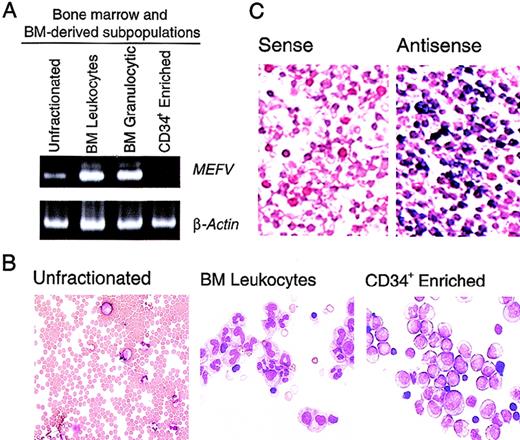 Fig. 1. MEFV expression in bone marrow leukocytes and precursor cells. / (A). Ethidium bromide (EtBr)–stained polyacrylamide gel electrophoresis (PAGE) of reverse transcriptase–polymerase chain reaction (RT-PCR) products of MEFV and β-actin messenger RNAs (mRNAs) from unfractionated bone marrow cells (lane 1), bone marrow leukocytes (lane 2), bone marrow granulocytic cells (lane 3), and an enriched population of CD34+ peripheral blood hematopoietic precursors (PBHP; lane 4). (B) Wright-Giemsa–stained cytospin preparations of the cells used for these analyses. Original magnification ×400. (C) Photomicrographs of Wright- Giemsa–stained in situ hybridizations of bone marrow leukocytes. Results with use of a gene-specific MEFV antisense riboprobe (right panel) and a nonspecific MEFV sense strand control riboprobe (left panel) are shown. Original magnification ×400.