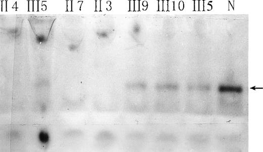 Fig. 2. Native gel electrophoresis of red-cell NADH-diaphorase. / The arrow indicates the position of NADH-diaphorase bands. N indicates a normal individual. Hemoglobin concentrations in all hemolysates were adjusted to 93 g/L, and 30 μL of each sample was loaded.