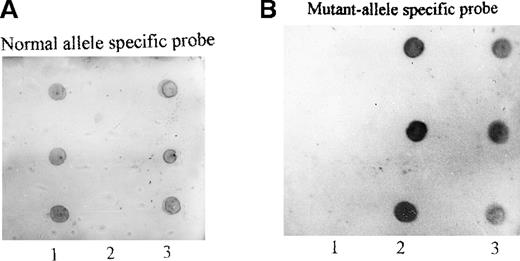Fig. 5. Dot blot hybridization of PCR-amplified genomic fragment spanning exon 7. / PCR products from the propositus, 5 of her family members, and 3 healthy individuals were hybridized with the normal allele-specific oligonucleotide probe (A) or mutant allele-specific oligonucleotide probe (B) as described in “Materials and methods”; 1: three normal controls; 2: three homozygotes from the family (from top to bottom: II.3, II.4, and II.7); 3: three heterozygotes (from top to bottom: III.5, III.9, and III.10).