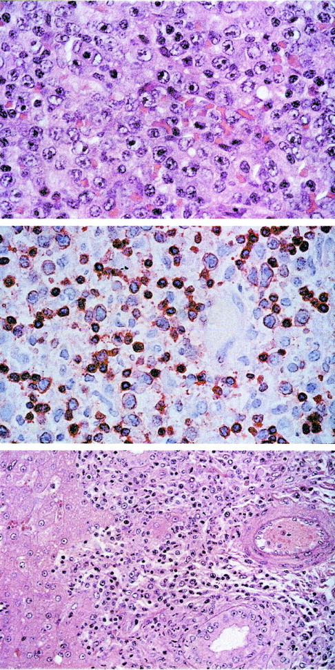 Fig. 3. T-cell lymphoma after intravenous infection with herpesvirus saimiri C488 of naive cynomolgus monkeys. / The tissue sections were stained with hematoxilin/eosin. Upper panel: Lymph node showing peripheral pleomorphic T-cell lymphoma with medium-sized and large blasts containing vesicular nuclei and prominent nucleoli (original magnification ×100). Central panel: Immunostaining of the medium-sized and large blasts and some accompanying small lymphocytes for CD3 (original magnification ×63). Lower panel: Infiltration of the portal tracts of the liver by the blast cells (original magnification ×40).