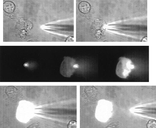 A sequence of images illustrating the gentle nature of SLAM-injection. / The uppermost 2 images show a human neutrophil that is loosely adhered and ruffling at the left-hand edge and at the beginning of the microinjection process. The SLAM injector contains lucifer yellow as a fluorescent (non-protein–binding) marker. The middle panel shows 3 fluorescent images (left) at contact between the SLAM-injector tip (in focus and brightly glowing) and then 8 seconds (middle) and 14 seconds (right) later. The transfer of fluorescent material into the cell can be seen. There is no indication of cell damage or response to the SLAM injection as evidenced by cell-shape change or recoiling of the ruffled membrane. The lowest panel shows the phase-contrast images at the end of SLAM injection, when a high level of uniform intracellular fluorescence is seen. (See Hallett and Laffafian9 for a movie of other SLAM injections.)