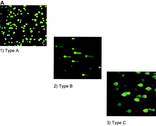 Fig. 4. HEL cell COMET assay. / (A) Depiction of different types of COMETs. (B) HEL cells treated with (1) 10 μmol/L GSNO (10× magnification); (2) 50 μmol/L GSNO (40× magnification); (3) 100 μmol/L GSNO; (4) cytokines to stimulate iNOS; and (5) cytokines in the presence of L-NMMA. YOYO-1 DNA stain was used on all parts of Figure 4.