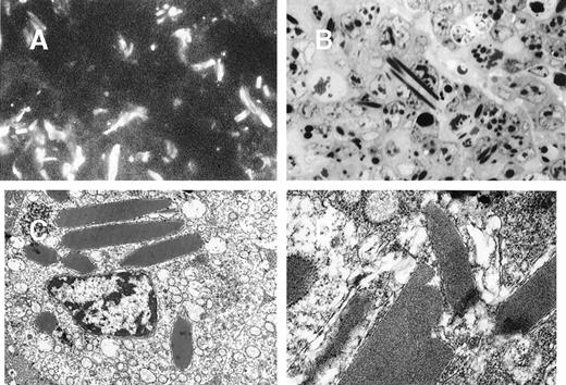 Fig. 3. Tumors induced by 8A4 cells grafted to mice. / Immunofluorescence microscopy with antimouse Ig conjugate (A, original magnification ×1000) and light microscopy (B, semi-thin section, toluidine blue staining, original magnification ×1000) showed numerous polymorphic crystals located in tumor cell cytoplasms. (C and D) Electron microscopy showed osmiophilic and highly organized crystalline inclusions in rough ergastoplasm cisternae with a periodicity of 12 nm (C, original magnification ×6000; D, ×25 000).