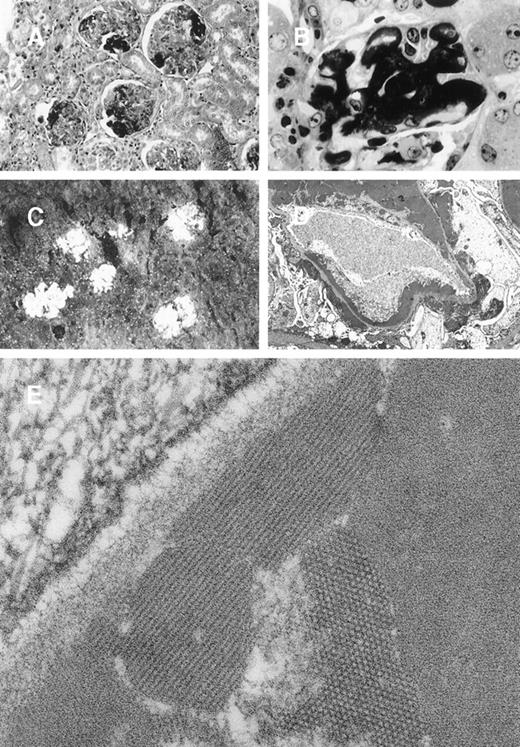 Fig. 4. Glomerular lesions in 8A4 mice kidneys. / (A and B) Light microscopy showing the proliferative and exudative changes (A, original magnification ×200, light green trichromic staining) and the voluminous depositions of material predominantly in mesangial and subendothelial areas (B, original magnification ×1000, semi-thin section, toluidine blue staining). (C) Immunofluorescence microscopy with antimouse Ig conjugate (original magnification ×200) showed intense staining of deposits strictly limited to glomeruli without any staining of peritubular capillary lumen. (D and E) Electron microscopy showed osmiophilic deposits in mesangial and subendothelial spaces (wire-loop lesion) with few subendothelial deposits. The glomerular capillary lumens were free of deposits (D, original magnification ×5000). Note the highly organized crystalline glomerular deposits formed by densely packed microtubules (external diameter = 12 nm) in transversal section and parallel arrays in longitudinal section with a 12-nm striation periodicity (E, original magnification ×60 000).