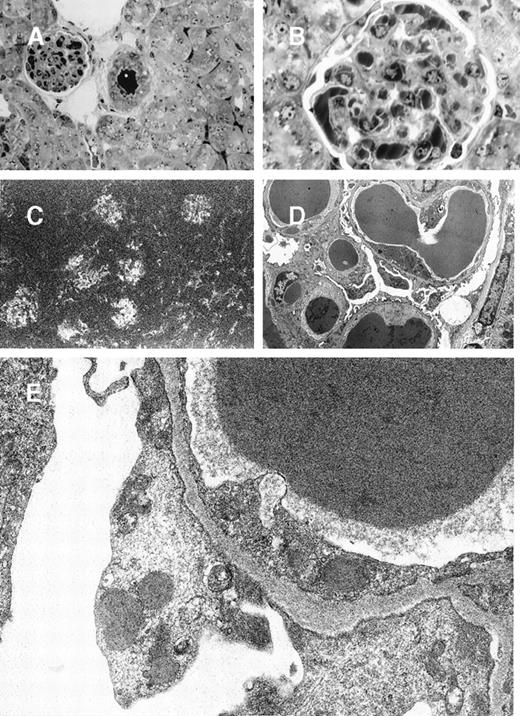 Fig. 5. 8A4-NP1 cryoglobulin, renal lesions observed in mice kidneys. / (A and B) Light microscopy showing intravascular precipitates not solely in glomerular capillary lumens but also in peritubular capillary and arteriolar lumens. Note the absence of inflammatory reaction. Semi-thin sections, toluidine blue staining (A, original magnification ×400; B, ×1000). (C) Immunofluorescence microscopy with antimouse Ig conjugate (original magnification ×200) showed staining of intravascular cryoglobulin aggregates. (D and E) Electron microscopy showed osmiophilic amorphous precipitates in capillary lumens without crystalline substructure and without any deposits in subendothelials spaces. Note also the amorphous dense bodies in epithelial and endothelial cell cytoplasms (D, original magnification ×2500; E, ×12 000).