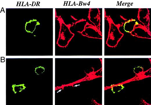 Fig. 3. DC acquisition of HLA-Bw4 molecules. / DCs were cultured on glass cover slips on a monolayer of nonirradiated melanoma cells. The cocultures were processed for immunofluorescence and confocal microscopy 20 hours later. (A, B) HLA-DR molecules expressed by DCs were visualized using an HLA-DR-FITC mAb and displayed as green staining. (A, B) HLA-Bw4 molecules were visualized by specific primary mAbs followed by a Texas red–conjugated second antibody and displayed as red staining. (A, B) Optically merged confocal images showed the colocalization, displayed as yellow staining, of the HLA-DR marker with HLA-Bw4 molecules on the cell surface of DCs. The transfer of cell membrane molecules starts from the point of contact between DCs and melanoma cells (B, indicated by arrows).