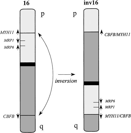 Fig. 1. Schematic representation of the inv(16). / Both CBFB and MYH11 genes are transcribed in the centromeric to telomeric direction. The inversion fuses the 5′ end of the CBFB gene, located on 16q22, upstream of the 3′ end of MYH11 on 16p13. The reciprocal fusion geneMYH11/CBFB is also generated in most of the cases. However, deletion of MYH11 sequences upstream of the 5′ breakpoint is reported in some cases.29