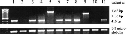 Fig. 2. Expression of inv(16) mRNA fusion products and β-2 microglobulin mRNA in AML patient samples, determined by RT-PCR. / The 416-bp, 1136-bp, and 1343-bp products of type A, C, and D are shown. The patient numbers correspond to the numbers in Table 1.