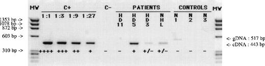 Fig. 1. RT-PCR amplification products of gene MAGE-A4. / Products were obtained with lymph node samples from patients with HD (HD11, HD5, HD3) or NHL and obtained with samples of normal lymphoid cells (N1, lymph node; N2, PBMC; N3, PHA-activated peripheral T cells). C+, positive control sarcoma line LB23-SARC. C−, negative control (no RNA present in the RT reaction). Amplification of MAGE-A4transcripts gives a band of 443 base pairs, distinct from that of the amplified genomic sequence of 517 base pairs (faintly visible in line N1). The levels of gene expression were evaluated by comparing band intensities with those obtained for serial dilutions (1:1, 1:3, 1:9, 1:27) from the positive and scored as follows : ++++, 100%; +++, 30% to 100%; ++, 10% to 30%; +, 3% to 10%; or ±, less than 3%. Absence of RT-PCR product is indicated as −. RNA integrity was assessed by RT-PCR amplification of the β-actin mRNA (data not shown).