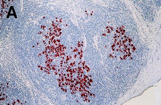 Fig. 2. Labeling of Reed-Sternberg cells with anti–MAGE-A4 MAb 57B in nodular sclerosing lymph nodes. / Patients include HD3 (A and B) and HD4 (C) at low (A), high (B) and intermediate (C) magnification. (B) and (C) correspond to MAGE-A4expression in HD3. Formalin-fixed sections were deparaffinized, heated in a citrate buffer, and incubated with MAb 57B. The antibody was detected with biotinylated secondary antibodies and avidin-coupled alkaline phosphatase. The chromogenic substrate was New Fuschin, and hematoxylin was used to counterstain the tissue.