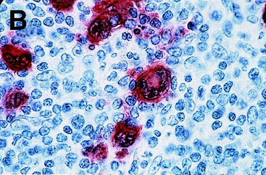 Fig. 2. Labeling of Reed-Sternberg cells with anti–MAGE-A4 MAb 57B in nodular sclerosing lymph nodes. / Patients include HD3 (A and B) and HD4 (C) at low (A), high (B) and intermediate (C) magnification. (B) and (C) correspond to MAGE-A4expression in HD3. Formalin-fixed sections were deparaffinized, heated in a citrate buffer, and incubated with MAb 57B. The antibody was detected with biotinylated secondary antibodies and avidin-coupled alkaline phosphatase. The chromogenic substrate was New Fuschin, and hematoxylin was used to counterstain the tissue.